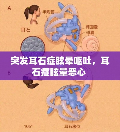 突发耳石症眩晕呕吐，耳石症眩晕恶心 