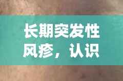 长期突发性风疹，认识、预防与治疗全攻略
